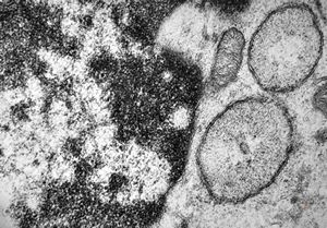 M,33y. | blood - hairy cell leukemia- ribosome-lamella complexin tricholeukocyte